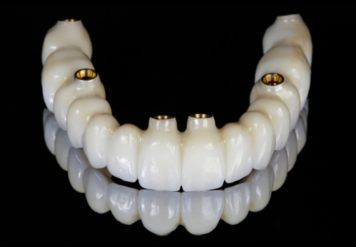 all-on-six-dental-implants-affordable-dentists-auckland-1