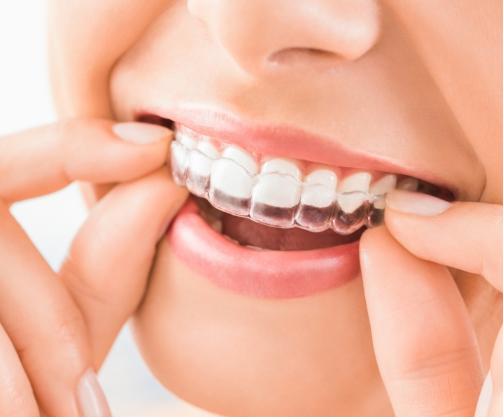 clear-aligners-affordable-dentists-auckland