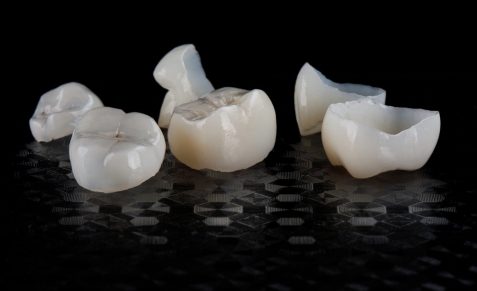 dental-crown-care-affordable-dentists-auckland-ver-1
