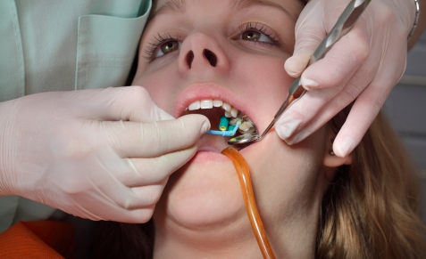 dental-deep-fillings-care-affordable-dentists-auckland-latest