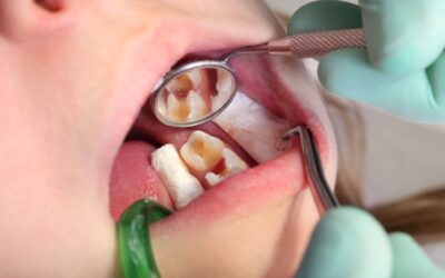 Dental Fillings: Restoring Your Smile