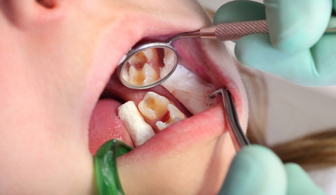 dental-fillings-affordable-dentists-auckland-nz