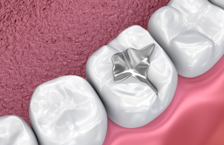 dental-fillings-affordable-dentists-auckland