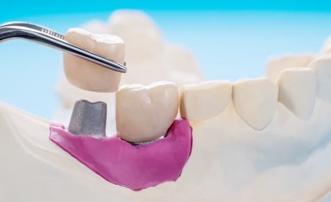 dental-implant-prosthetics-care-affordable-dentists-auckland-latest