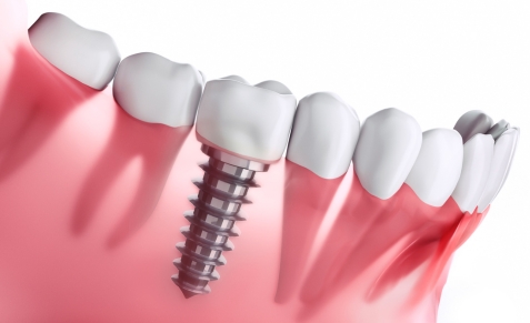 dental-implants-auckland-ver-1-1