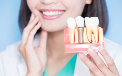 How Much Do Dental Implants Cost in Auckland NZ? (2026 Price Guide)