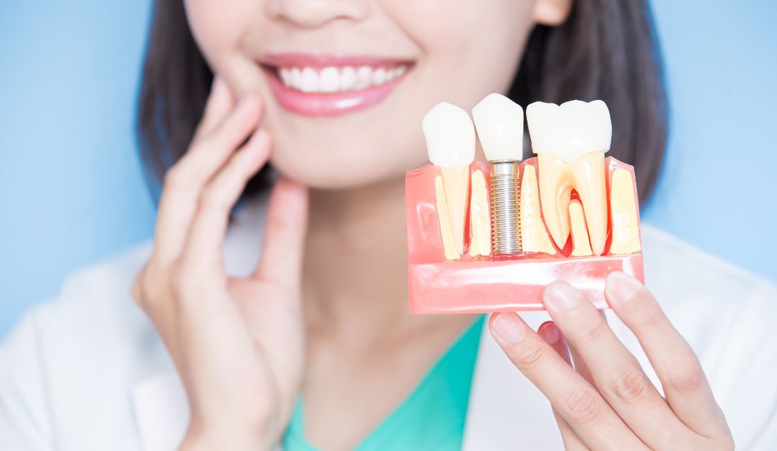 dental implants cost Auckland NZ Affordable Dentist