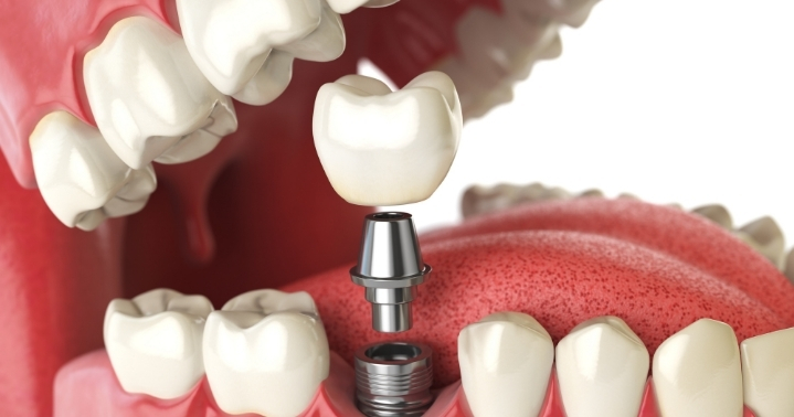 dental-implants