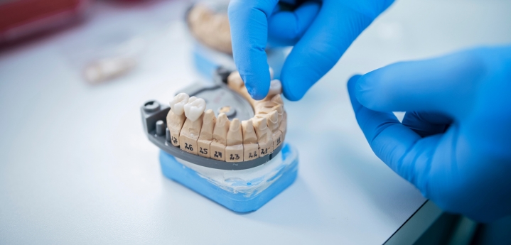 full-mouth-dental-implants-affordable-dentists-auckland