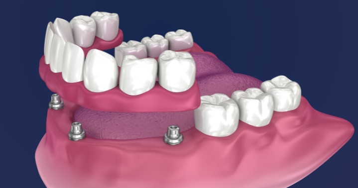 multiple-teeth-implants-affordable-dentists-auckland