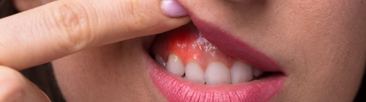 periodental-gum-disease-treatment-affordable-dentists-auckland