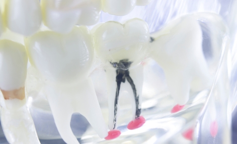 root-canal-treatment-stage-1-care-affordable-dentists-auckland-latest
