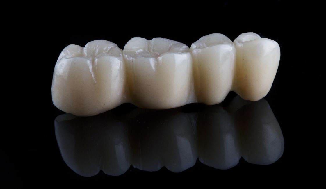 same-day-dental-crown-bridges-affordable-dentists