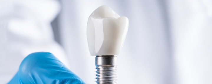 single-tooth-implant-affordable-dentists-auckland