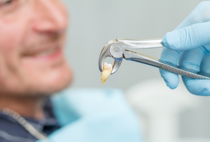 tooth-extraction-northcross-dentists-auckland